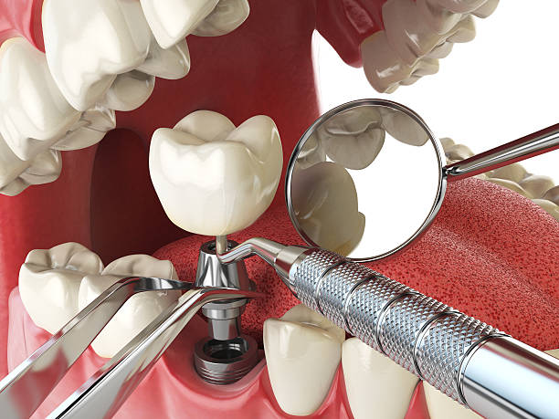 Best Emergency Dental Care for Broken or Chipped Teeth in Fair Plain, MI